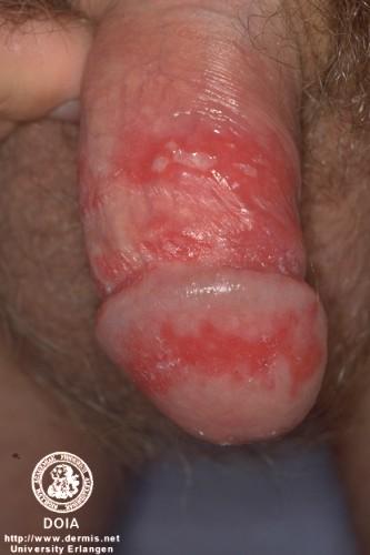                Herpes blisters 