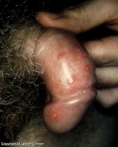 Herpetic ulcers