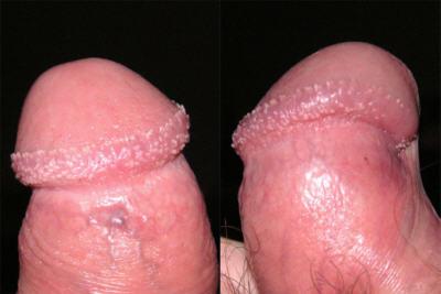    Pearly papules 